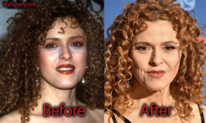 Bernadette Peters Plastic Surgery Before and After Botox Injections