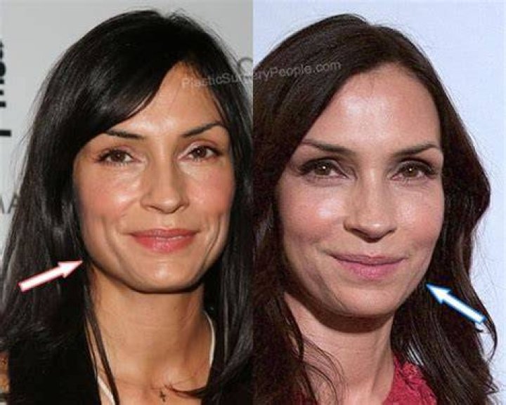 Famke Janssen Plastic Surgery Before and After Botox Injections