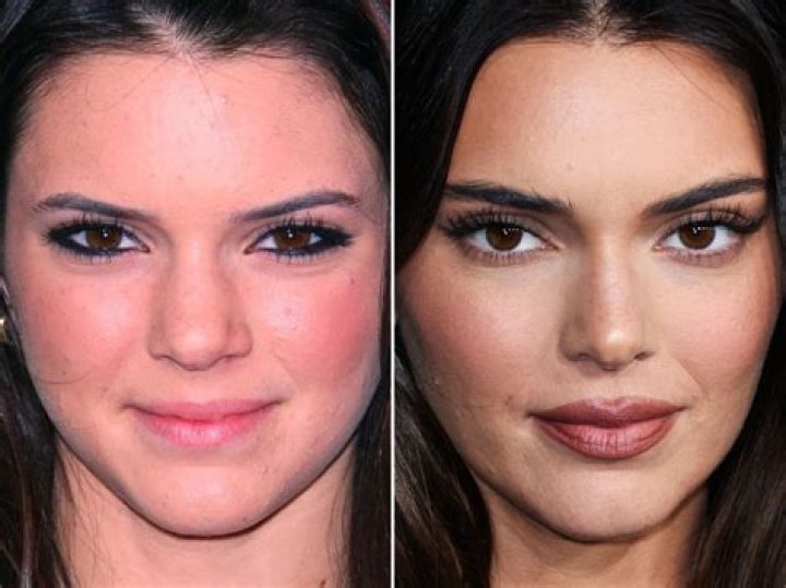 Kendall Jenner Plastic Surgery: Does She Really Get Plastic Surgery?