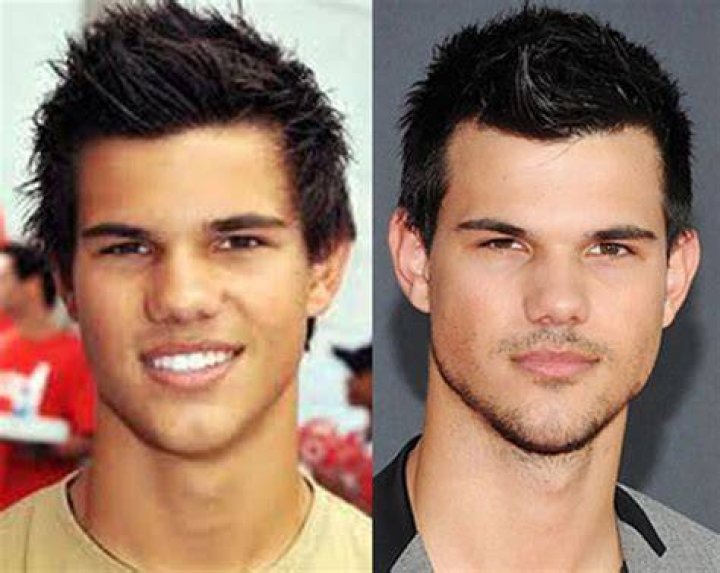 Taylor Lautner Nose Job Plastic Surgery Before and After
